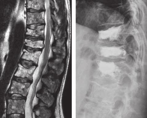 556 H. MAJEED, R. BOMMIREDDY, Z. KLEZL successful application of cement augmentation (vertebroplasty) for a patient with vertebral fracture secondary to multiple myeloma (6,7).