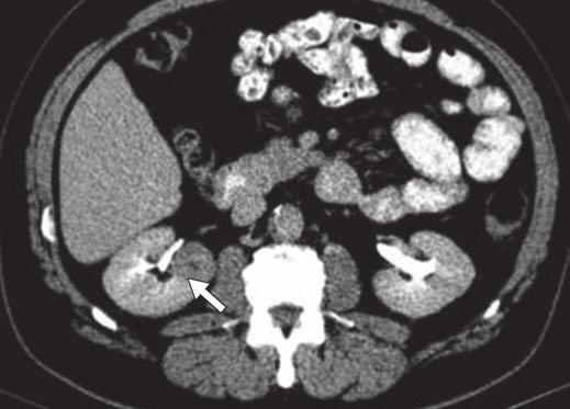 collecting system (3 points) (Figs. 4 and 5). The A descriptor indicates the anterior or posterior location of the tumor and is not assigned a point value.