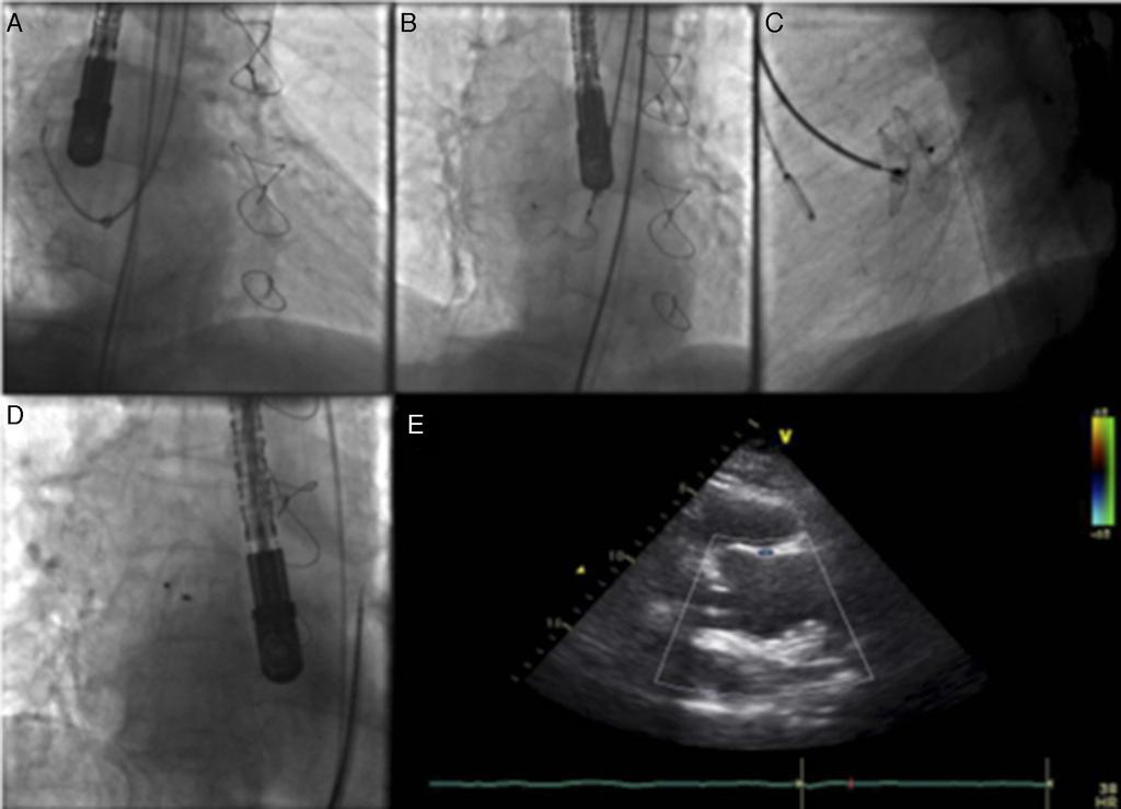 Percutaneous closure of a large ascending aortic pseudoaneurysm 119.e3 Figure 2 Images illustrating percutaneous closure of aortic pseudoaneurysm.