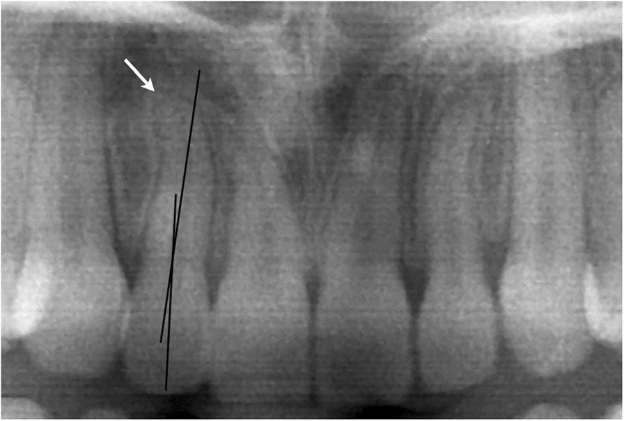 Kanavakis et al. Progress in Orthodontics (2015) 16:4 Page 3 of 6 Figure 2 Dilacerations at the root apex were not regarded when defining the long axis of the root.