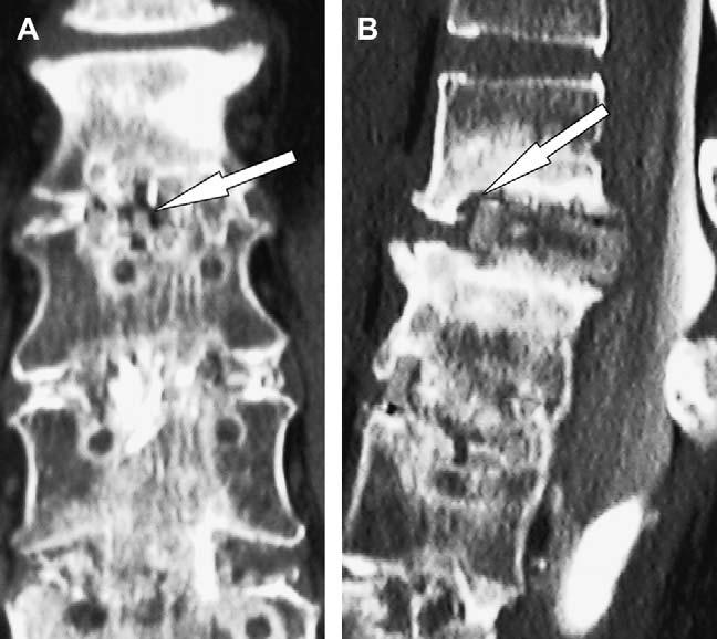426 G.R. Fogel et al. / The Spine Journal 6 (2006) 421 427 Fig. 3. (A) Patient 9, a 48-year-old woman with nonunion L1 L2 above previously healed L2 L5 posterior lumbar interbody fusion.
