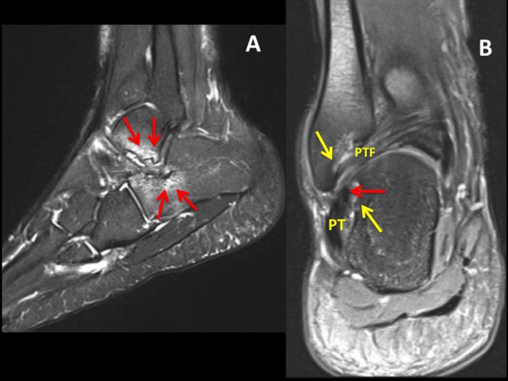 Fig. 5: A; Sagittal T2-wd fat saturated image shows abnormal contact between calcaneus and talus with opposing bone marrow edema and cystic changes in a case with lateral hindfoot impingement.