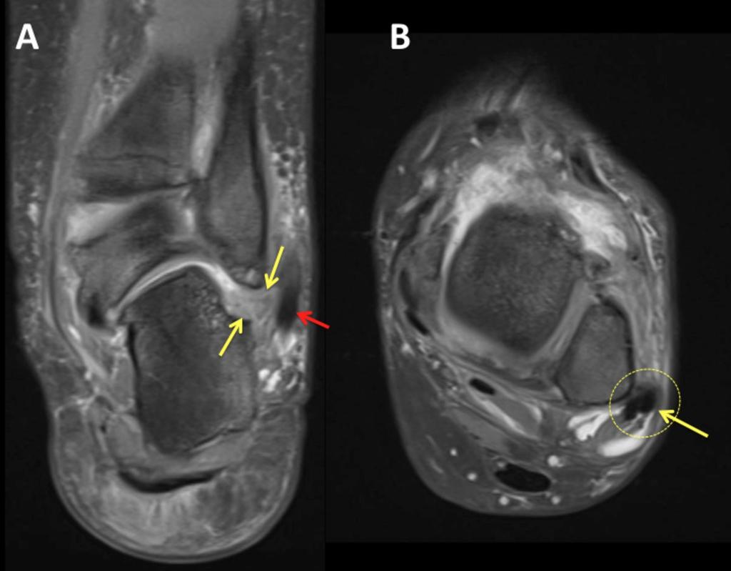 Fig. 6: A; Due to hindfoot valgus, soft tissue edema and impingement is seen between the fibula and the calcaneus (yellow arrows) without prominent bony changes (red