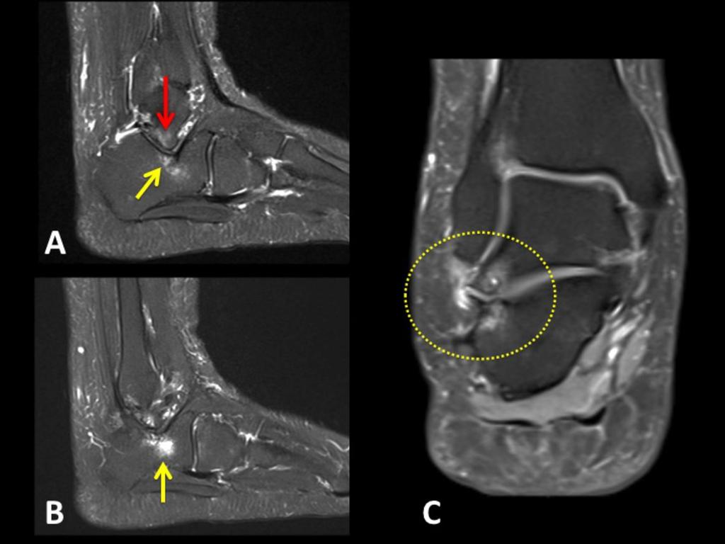 Fig. 1: Weight bearing radiograph shows direct contact between the talus and the calcaneus and sclerotic changes (arrows). Fig.