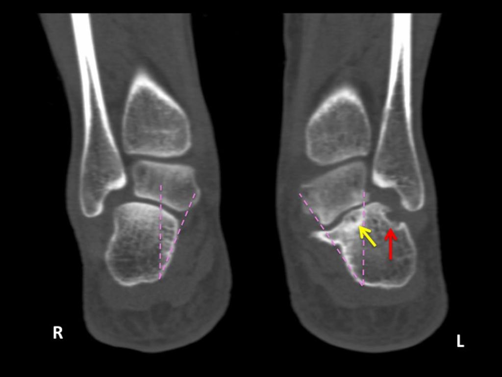 Fig. 3: Coronal CT image shows calcaneal facet articulating with distal fibula (red arrow).