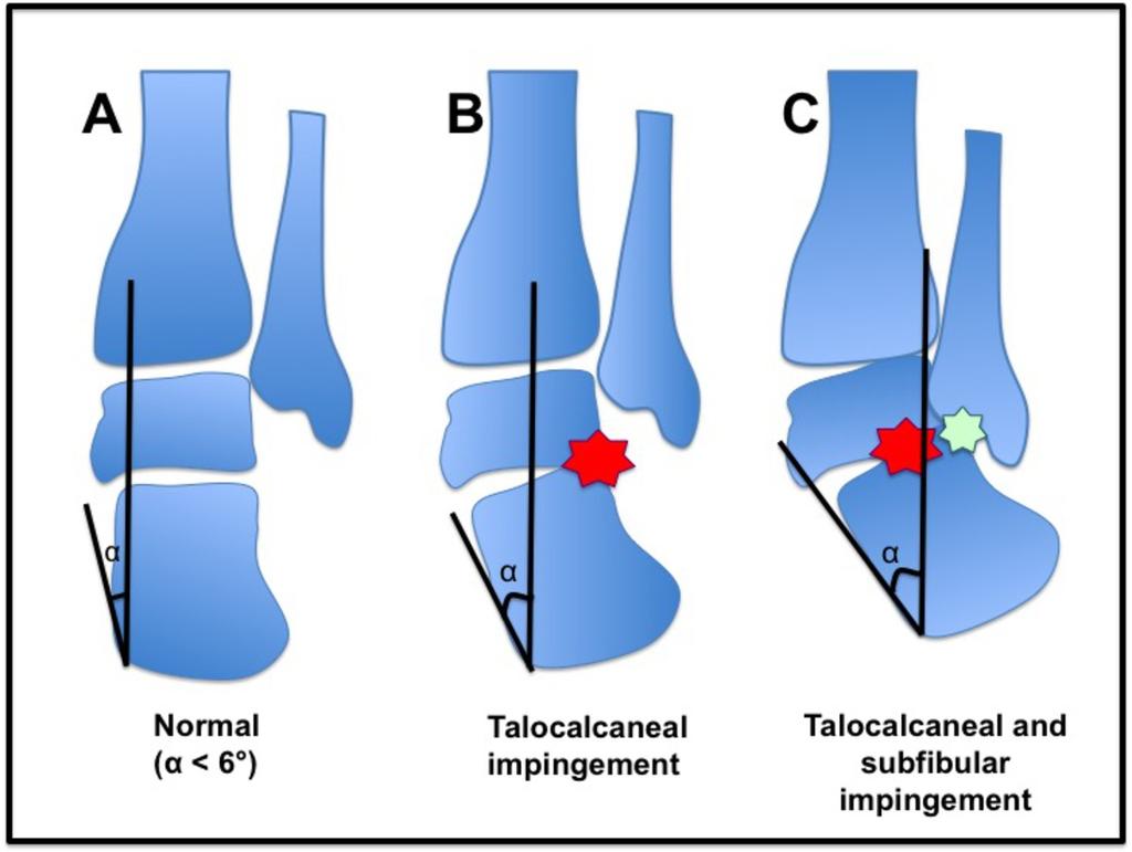 Fig. 4: Illustration shows lateral hindfoot impingement (A; normal, B; talocalcaneal impingement with hindfoot valgus, C; combined talocalcaneal and subfibular impingement with progressive