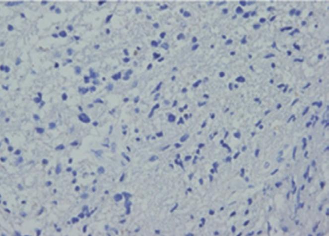 Immunohistochemical expression of IDH-1 in glioblastomas Immunohistochemical expression of IDH-1 was noted in 16 (11.1%) of 144 total cases (Fig. 1C, F).
