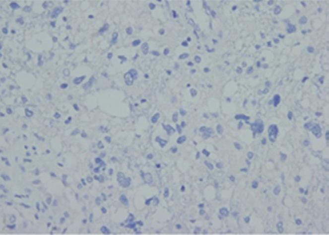 Immunohistochemical subtypes in clinically primary and secondary glioblastomas Clinically secondary glioblastomas were observed in only 4 cases (2.