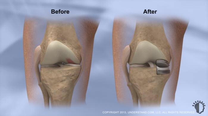 Recovery and Results The smaller incision used for a partial knee replacement makes for a quicker recovery than a total knee replacement.
