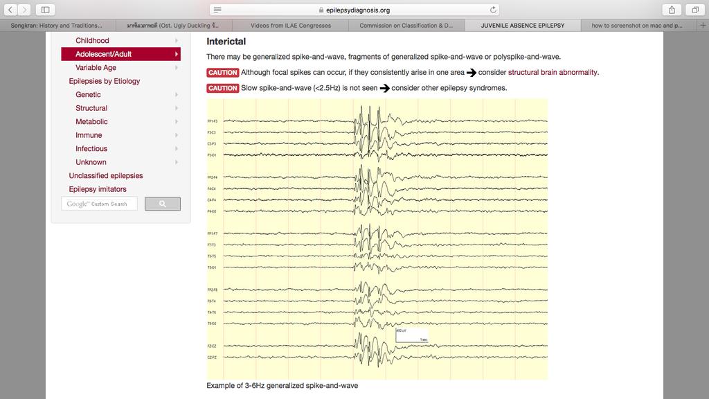 13 14 Juvenile myoclonic epilepsy JAE-EEG Clinical: age onset 8-25 y/o myoclonic seizures and generalized convulsions, 5% of cases evolve from CAE, 5-10% -febrile seizures Developmental, cognitive