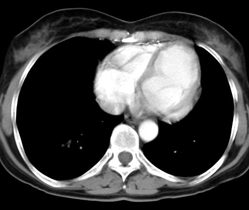 The same homogenous, uniform echostructure of the mass. Fig. 9 Thoracic CT scan.