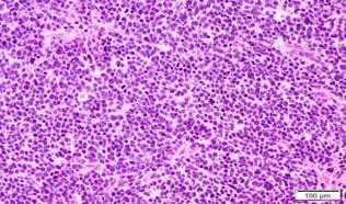 WD NE Tumor PD NE Carcinoma Grading of Pancreatic Neuroendocrine Neoplasms (WHO 2017) Stable Disease Grade Progression NE Tumor Lower Grade High Grade Carcinoma NE Carcinoma High Grade Rapid Disease