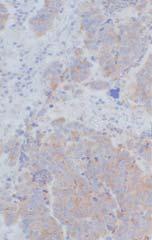Cell Carcinoma with Neuroendocrine