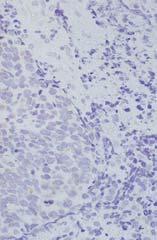Carcinoma Large Cell Neuroendocrine