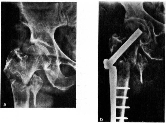 THEATMENT OF METASTATIC PATHOLOGICAL FRACTURES 545 Figure 4.