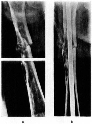 546 ERKKI V. S. KOSBINEN & HAIMO A. NIEMINEN Figure 5. Fracture of diaphusis of the femur in the large bone destruction area of a metastasis from mammaru carcinoma (a).