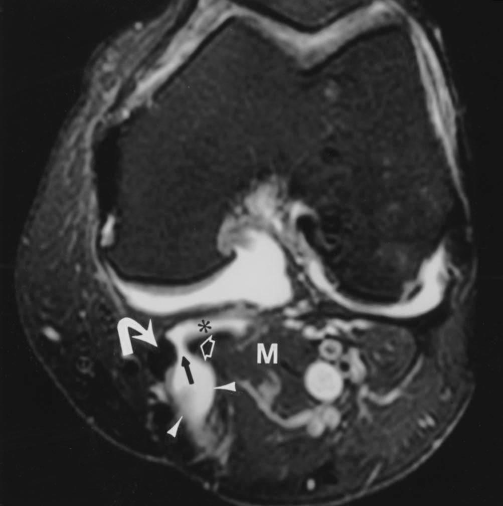 Sonography and MR Imaging of aker s Cysts Fig. 2. 60-year-old woman with aker s cyst.