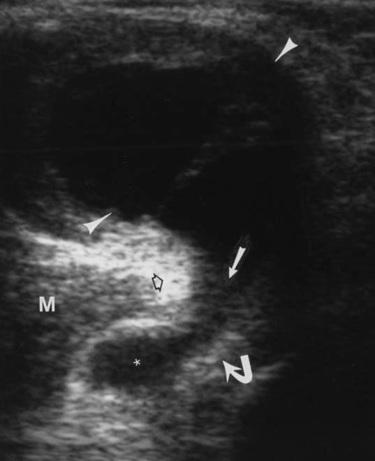 and medial gastrocnemius tendon (open arrow). Note subgastrocnemius component (asterisk) of aker s cyst.
