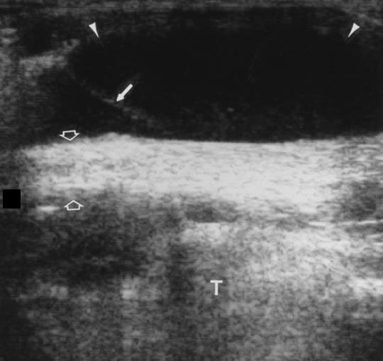 , Sagittal sonogram of posterior knee shows aker s cyst (arrowheads). Note septation (solid arrow).