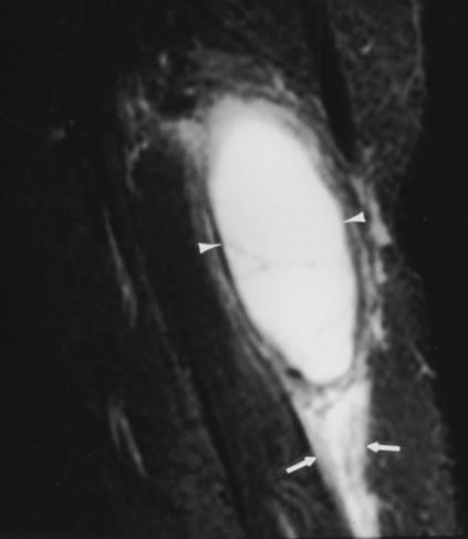 Ward et al. Fig. 4. 62-year-old man with rupture of aker s cyst.