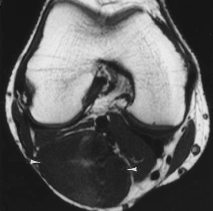 cyst. The presence of septations resulted in a sensitivity of 47%, specificity of 0%, positive predictive value of 80%, negative predictive value of 0%, and accuracy of 42%.