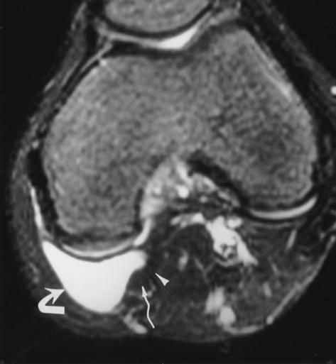 Sonography and MR Imaging of aker s Cysts Fig. 7. 13-year-old girl with meniscal cyst.
