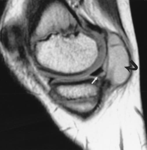 Note that top of image is posterior; left side of image is superior. F = femur, c = hyaline cartilage.