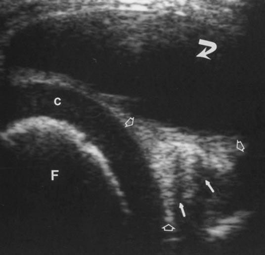 C, xial proton density weighted MR image with fat saturation reveals meniscal cyst (curved arrow) with signal intensity of fluid without extension between semimembranosus tendon (undulating arrow)