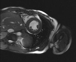 Cardiac MRI Black-Blood (Spin-Echo) White-Blood SSFP Delayed Enhancement Still Images