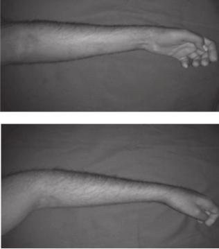 3 Fig-1. Mild type of VIC with mild wrist & finger flexion and pronation deformity of forearm Fig-2. Moderate type of VIC with moderate degree of wrist & finger flexi on, forearm pronation Fig-3.