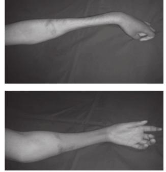 Murphy (1914) and later on, Jepson (1926) demonstrated that early decompression of the limb would prevent the 13,14 sequelae of paralysis and contracture.