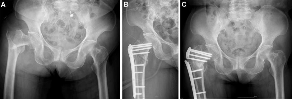 Reverse LISS plate in treating femoral intertrochanteric fractures: A review of 22 cases Fortunately, no further treatment was required for fracture malunion.
