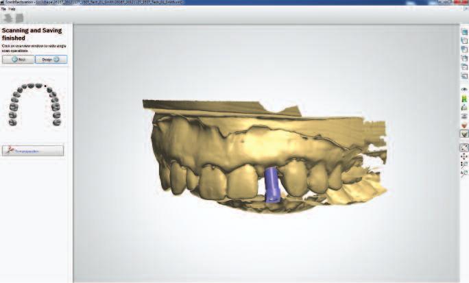 Instructions For Scanning A Stone Model With An Occlusal