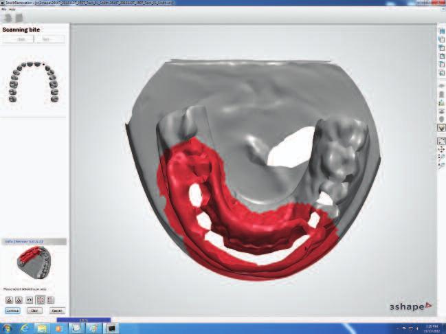 Instructions For Scanning A Stone Model With An Occlusal Registration
