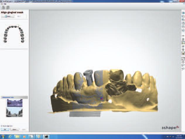 Instructions For Scanning A Stone Model With An Occlusal Registration (continued) 22. Place the model back in the scanner and click next (the rough scan image will appear). 23.