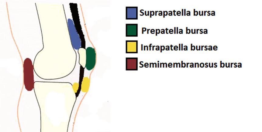 Knee joint bursae: 1- Subpopliteus bursa; between popliteus tendon & lateral femoral condyle.