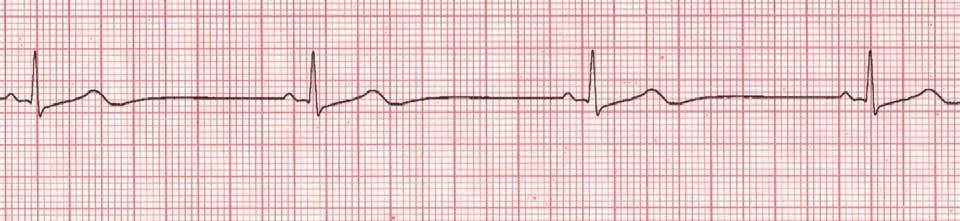 4. Cardiac Core Cases Supraventricular Tachycardia (SVT) - SUSTAINED - Rapid, narrow QRS, regular rhythm tachycardia with a rate > 180 in children and > 220 in infants Use the Pediatric Assessment