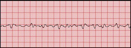 o If CPR, Epinephrine, and treating reversible causes, are ineffective, be prepared for transcutaneous pacing Ventricular Fibrillation (V-Fib/VF) Pulseless Ventricular Tachycardia (VT/V-Tach) Both