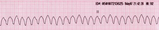 Once you determine your patient has one of these arrhythmias (completed your BLS survey and identified the rhythm), proceed as follows: Initiate Code Blue and begin chest compressions Defibrillate