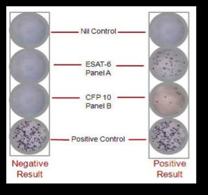 Interpretation of T-SPOT.TB The T-SPOT.TB assay is read using 4 circles which depict the Nil Control, Panel A (ESAT-6), Panel B (CFP 10 antigen) and a positive control.