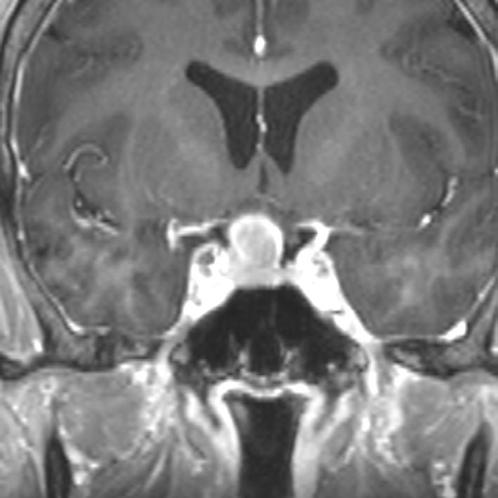 A few exceptionl cses with unusul loctions such s the juxtventriculr region, left temporoprietl cortex, nd thlmic pulvinr re (3) hve een reported.
