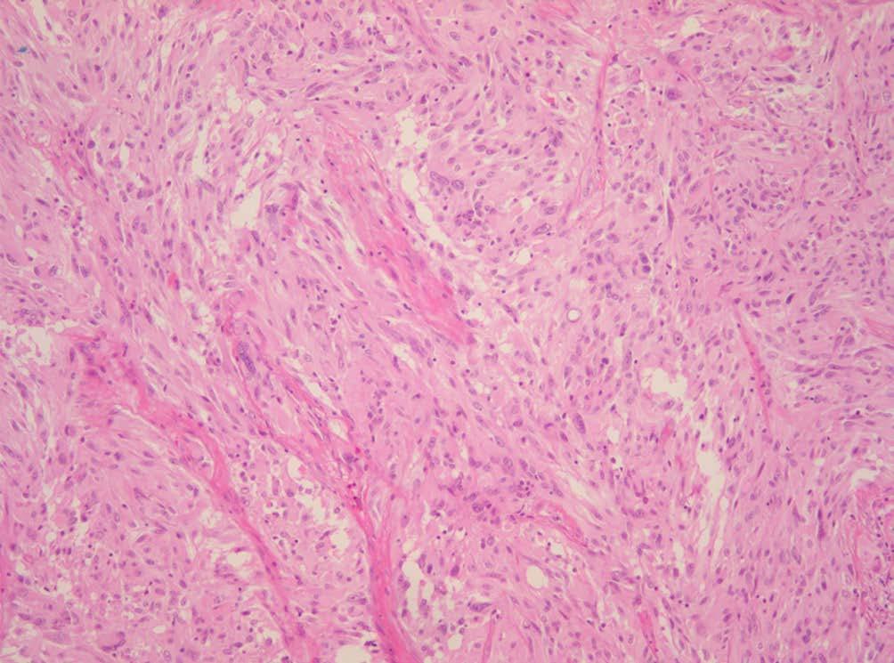 Chordoid Gliom in the Intr- nd Supr-sellr Regions Jisun Hwng, et l. Fig. 3. Histologicl fetures of the tumor.