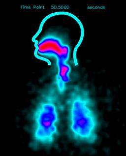 Lung deposition HFA BDP (Qvar) & fluticasone (Flovent) 29% Oropharynx deposition 78% 53% Lung deposition 13% HFA BDP fluticasone ciclesonide (Alvesco), flunisolide HFA (Aerospan ) depositions similar
