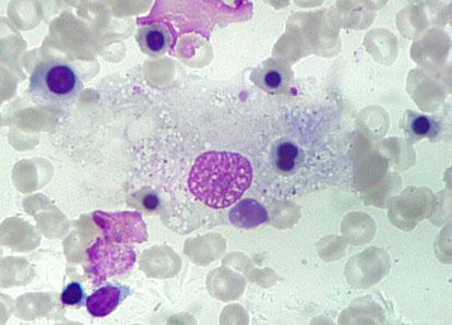 Med Oncol (2011) 28:539 543 541 Fig. 1 May-Grünwald-Giemsa stain of the bone marrow aspirate smears (91000).