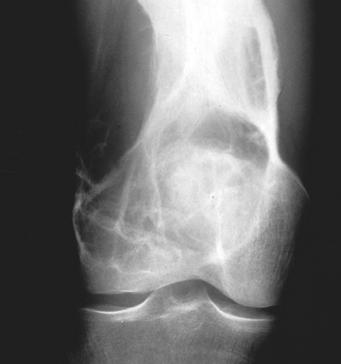 Because of its relative rarity, desmoplastic fibroma of the bone has been described in only a few small series in the orthopedic, pathology, and radiology literature.
