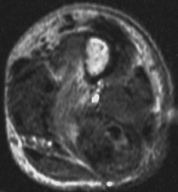 T2 Characteristics of Desmoplastic Fibroma of Bone Fig. 5. T1-weighted MR image (TR/TE, 460/50) of 30-year-old man also shown in Fig.