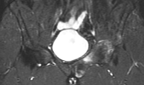 2 and 8 shows lesion is isointense to muscle. Fig. 7. Coronal PD-weighted image (TR/TE, 4,560/39) image of 30-year-old man also shown in Figs. 1 and 5.