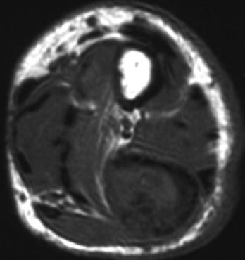 8 Axial T2-weighted MR image (TR/TE, 2,000/80) of right ulna of 75-year-old man also shown in Figs. 2 and 6 shows more than 75% T2 shortening of long, osteolytic lesion.
