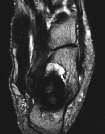 Frick et al. speculated that the muscle component of the tumor was responsible for the short T2 [15].