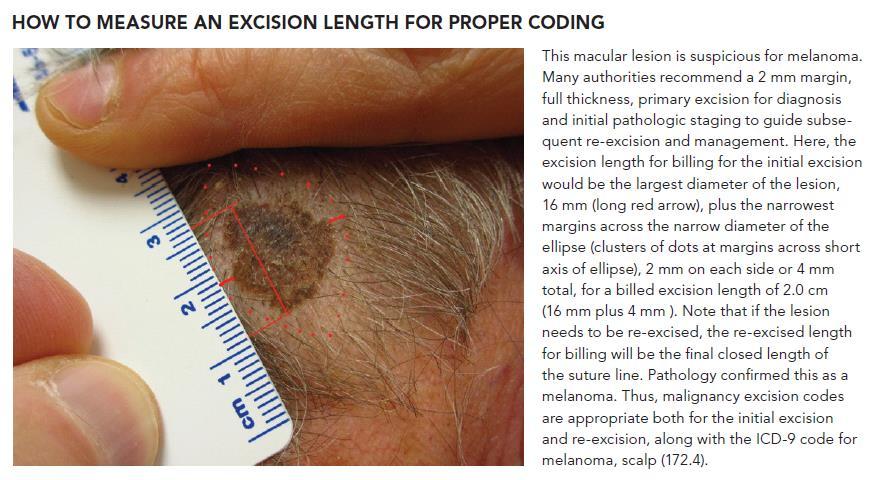 Excision Codes - Pearls Measure first, Cut Second!